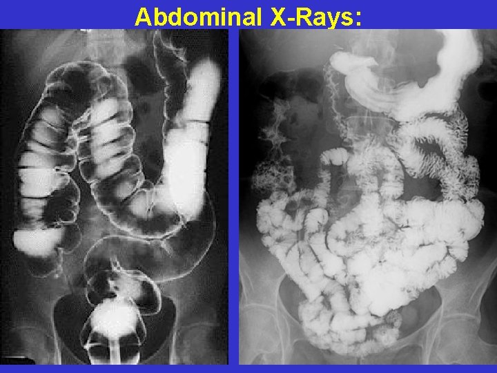 Abdominal X-Rays: AXR-3 AXR-4 