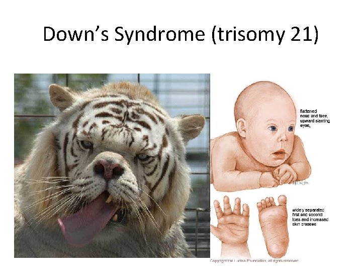 Down’s Syndrome (trisomy 21) • Such children are born with an extra chromosome #21