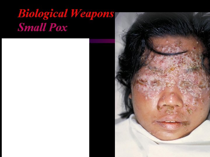 Biological Weapons Small Pox 
