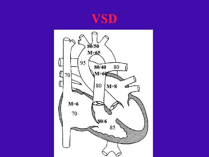 VSD 80/50 M=65 95 70 80/40 M=60 80 80 M=8 M=6 70 80/6 85