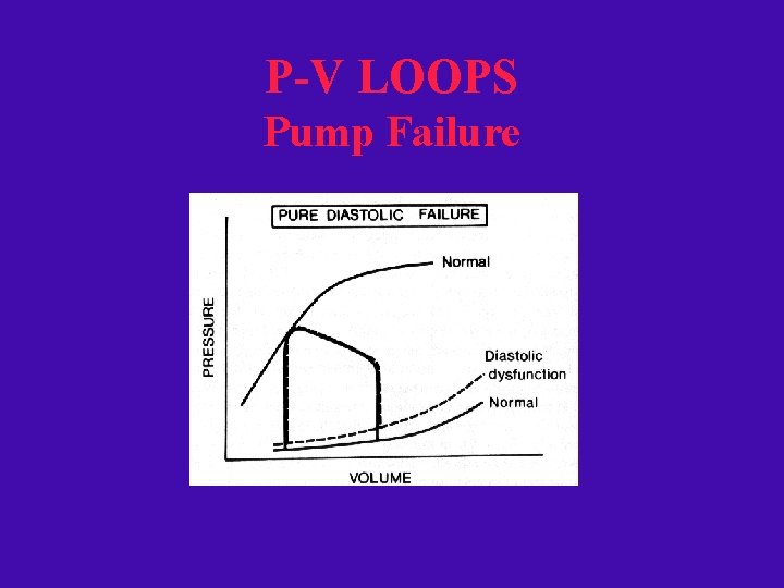 P-V LOOPS Pump Failure 