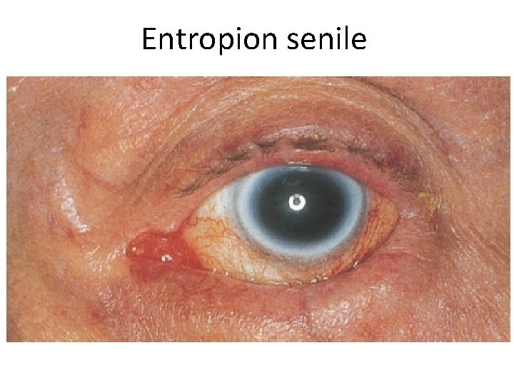 Entropion senile 