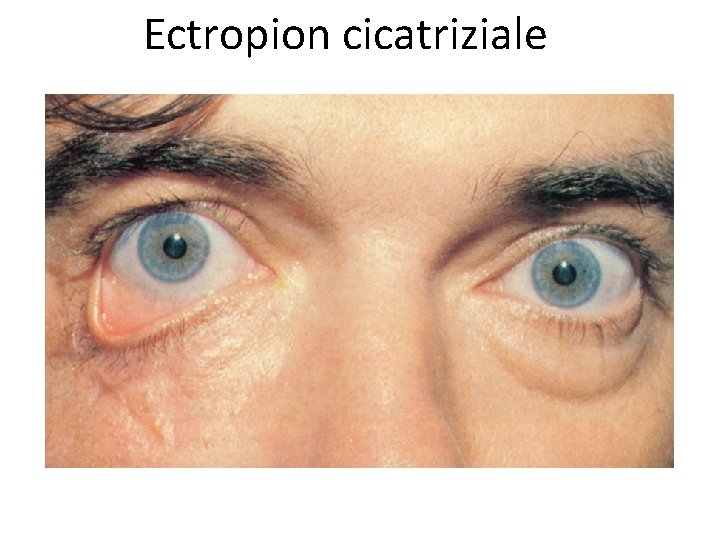 Ectropion cicatriziale 