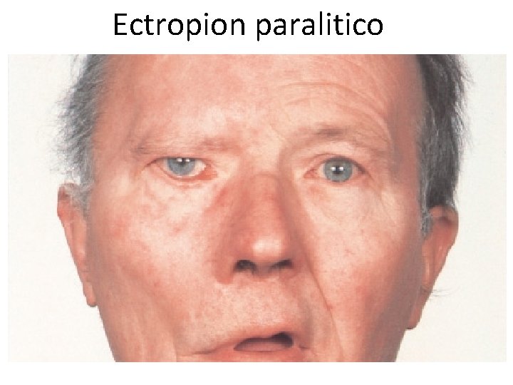 Ectropion paralitico 