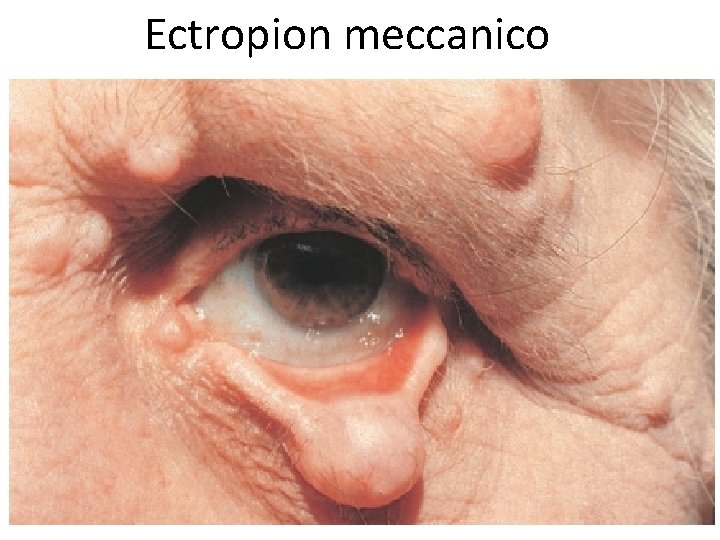 Ectropion meccanico 