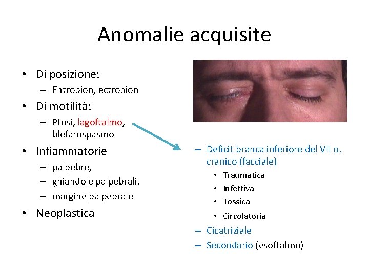 Anomalie acquisite • Di posizione: – Entropion, ectropion • Di motilità: – Ptosi, lagoftalmo,