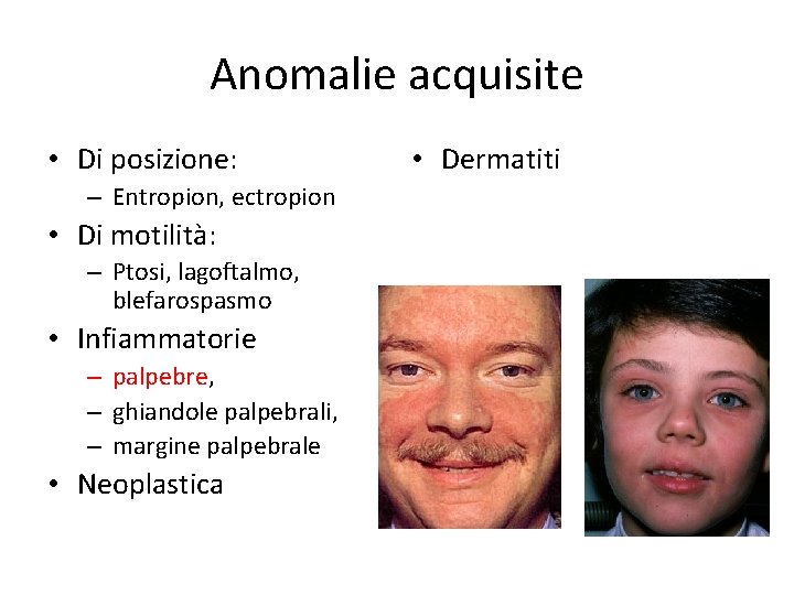 Anomalie acquisite • Di posizione: – Entropion, ectropion • Di motilità: – Ptosi, lagoftalmo,