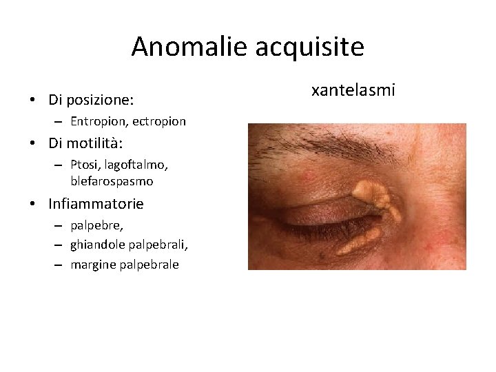 Anomalie acquisite • Di posizione: – Entropion, ectropion • Di motilità: – Ptosi, lagoftalmo,