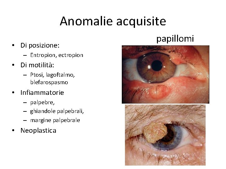 Anomalie acquisite • Di posizione: – Entropion, ectropion • Di motilità: – Ptosi, lagoftalmo,