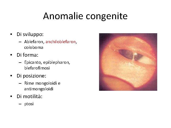 Anomalie congenite • Di sviluppo: – Ablefaron, anchiloblefaron, coloboma • Di forma: – Epicanto,