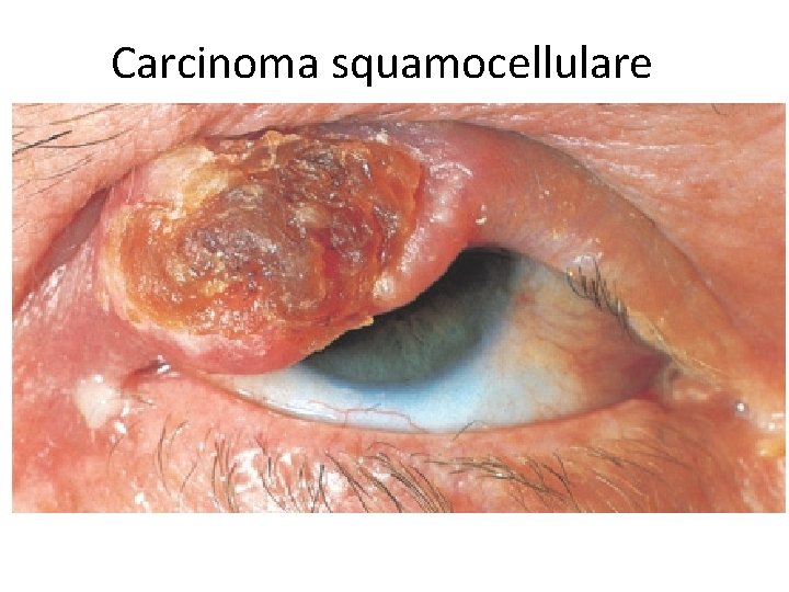 Carcinoma squamocellulare 