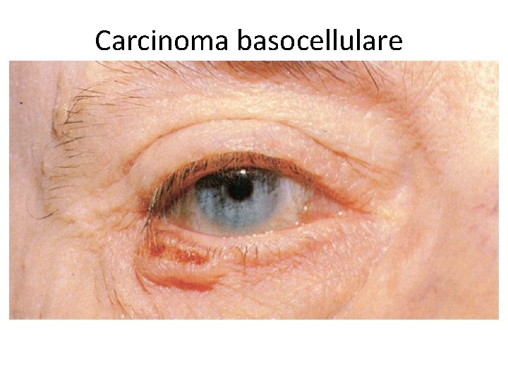 Carcinoma basocellulare 