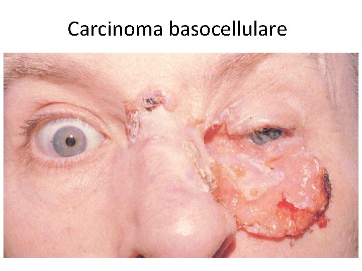 Carcinoma basocellulare 