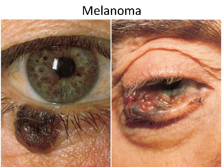 Melanoma 