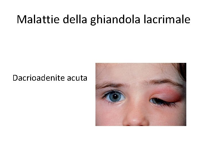 Malattie della ghiandola lacrimale Dacrioadenite acuta 