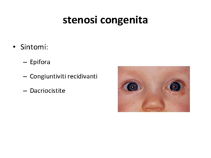 stenosi congenita • Sintomi: – Epifora – Congiuntiviti recidivanti – Dacriocistite 