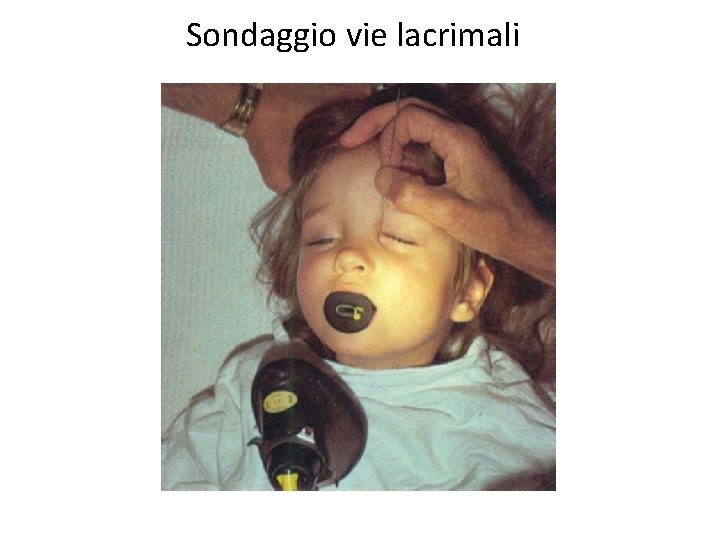 Sondaggio vie lacrimali 