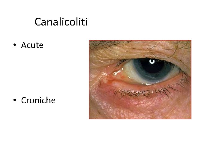 Canalicoliti • Acute • Croniche 