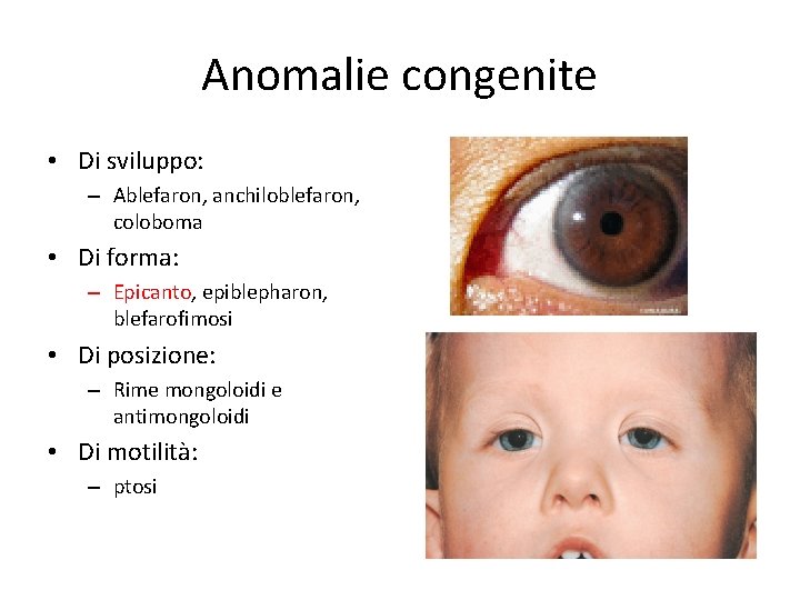 Anomalie congenite • Di sviluppo: – Ablefaron, anchiloblefaron, coloboma • Di forma: – Epicanto,