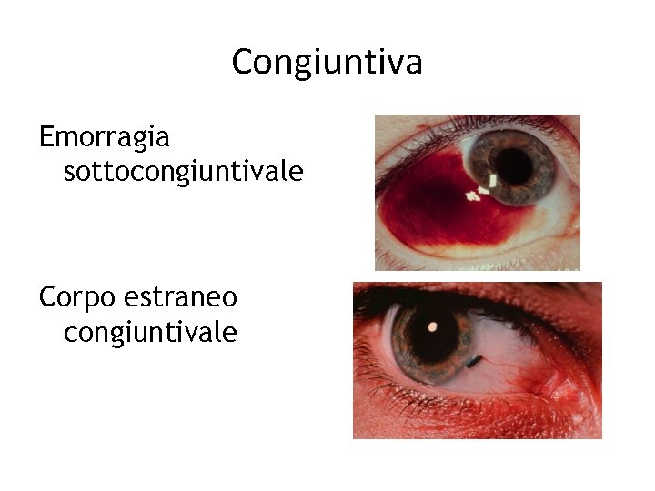 Congiuntiva Emorragia sottocongiuntivale Corpo estraneo congiuntivale 