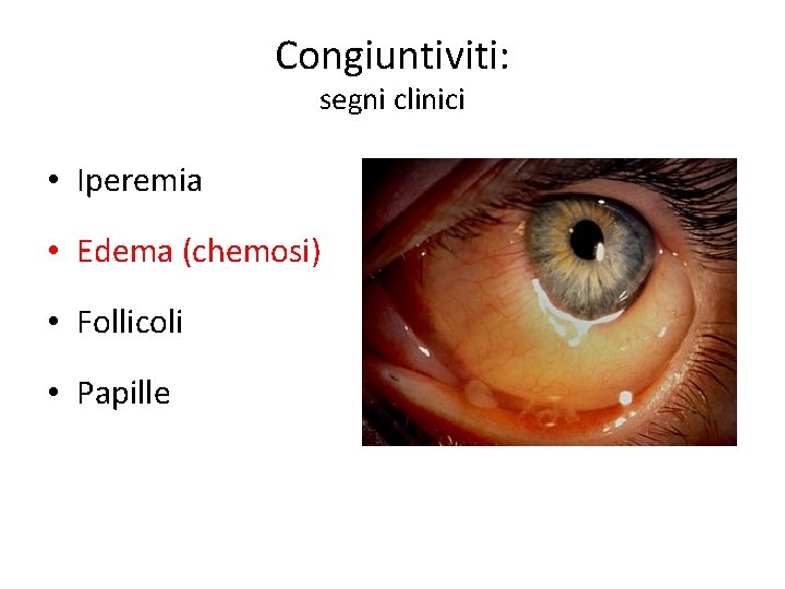 Congiuntiviti: segni clinici • Iperemia • Edema (chemosi) • Follicoli • Papille 