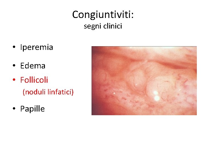 Congiuntiviti: segni clinici • Iperemia • Edema • Follicoli (noduli linfatici) • Papille 