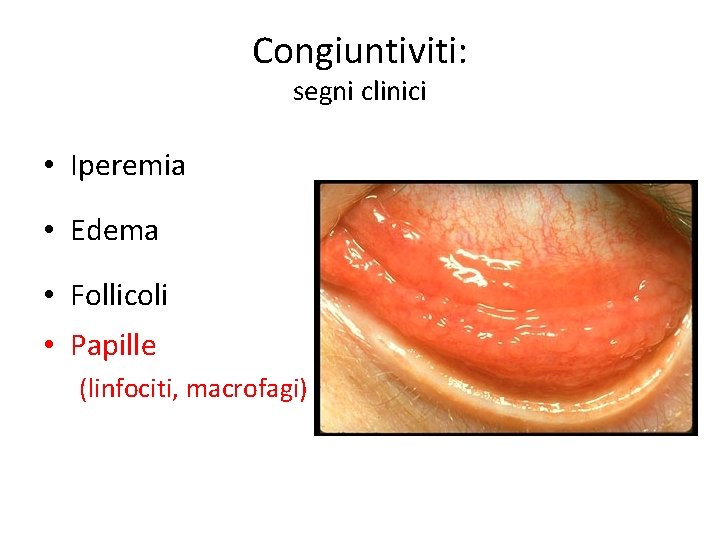 Congiuntiviti: segni clinici • Iperemia • Edema • Follicoli • Papille (linfociti, macrofagi) 