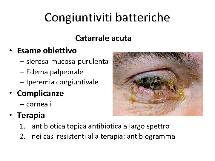 Congiuntiviti batteriche Catarrale acuta • Esame obiettivo – sierosa-mucosa-purulenta – Edema palpebrale – Iperemia