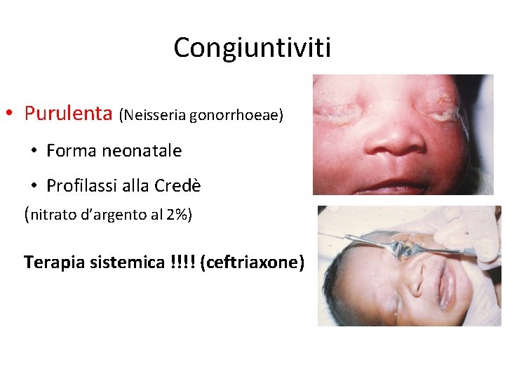 Congiuntiviti • Purulenta (Neisseria gonorrhoeae) • Forma neonatale • Profilassi alla Credè (nitrato d’argento