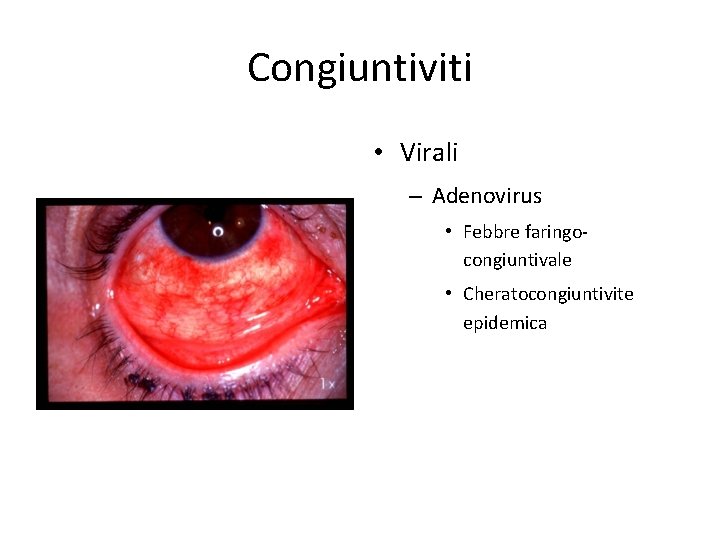 Congiuntiviti • Virali – Adenovirus • Febbre faringocongiuntivale • Cheratocongiuntivite epidemica 