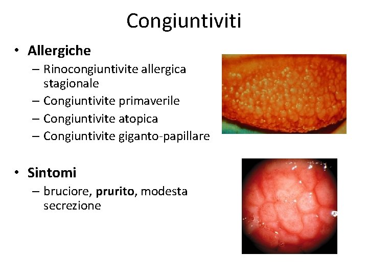 Congiuntiviti • Allergiche – Rinocongiuntivite allergica stagionale – Congiuntivite primaverile – Congiuntivite atopica –