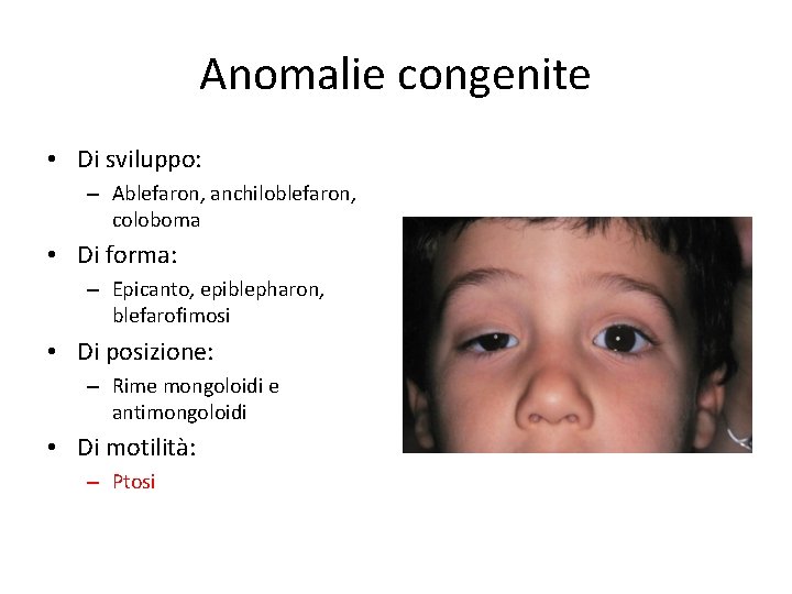 Anomalie congenite • Di sviluppo: – Ablefaron, anchiloblefaron, coloboma • Di forma: – Epicanto,