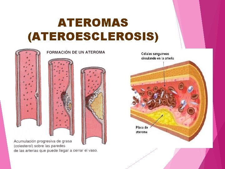 ATEROMAS (ATEROESCLEROSIS) 