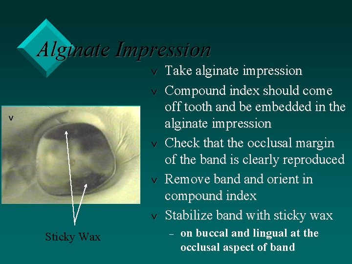 Alginate Impression v v v Sticky Wax Take alginate impression Compound index should come