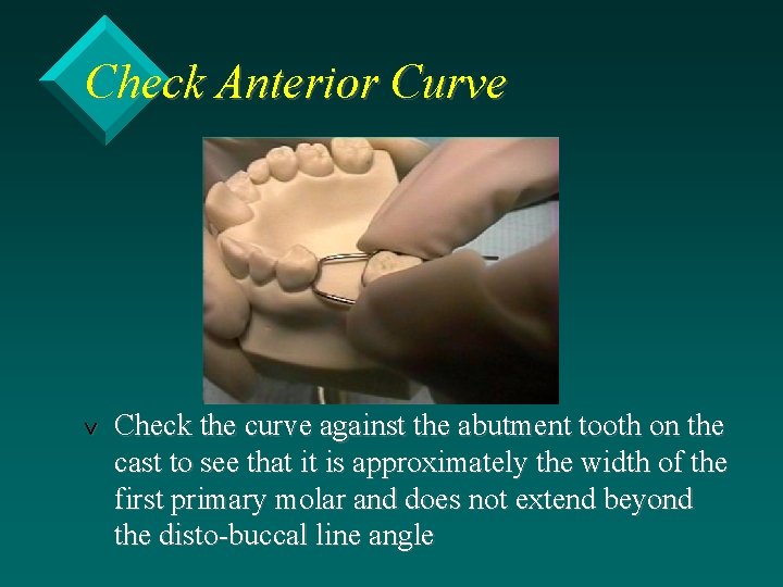 Check Anterior Curve v Check the curve against the abutment tooth on the cast