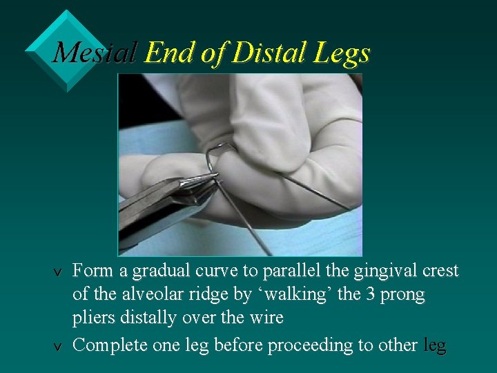 Mesial End of Distal Legs v v Form a gradual curve to parallel the