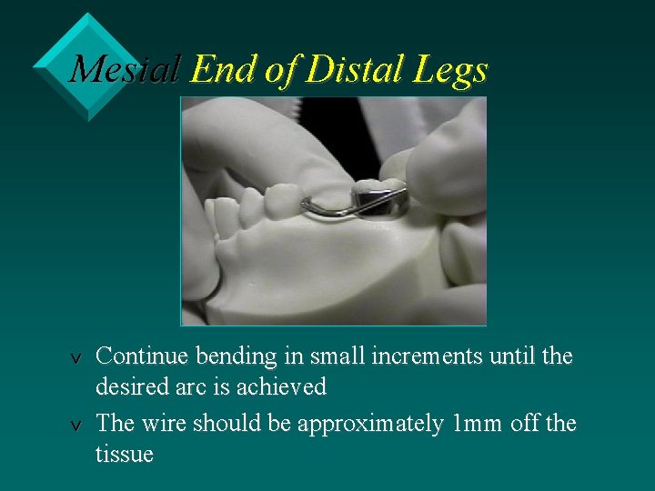 Mesial End of Distal Legs v v Continue bending in small increments until the