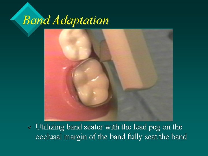 Band Adaptation v Utilizing band seater with the lead peg on the occlusal margin