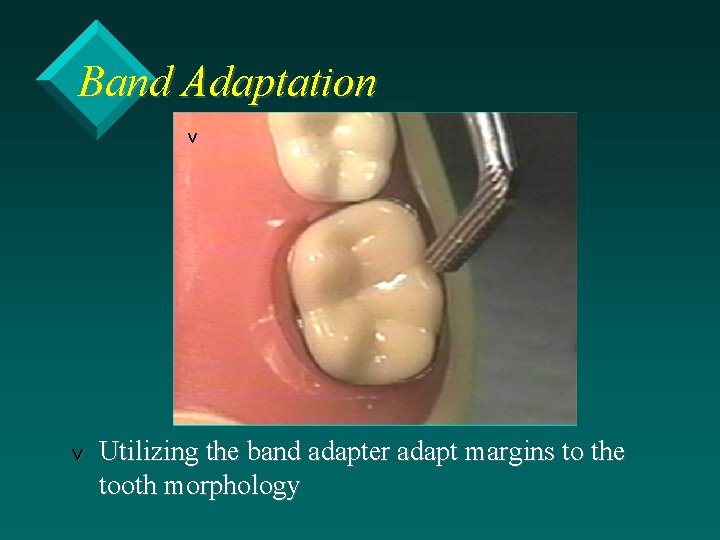 Band Adaptation v v Utilizing the band adapter adapt margins to the tooth morphology