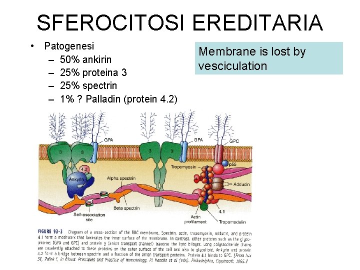 SFEROCITOSI EREDITARIA • Patogenesi – 50% ankirin – 25% proteina 3 – 25% spectrin