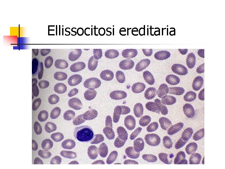 Ellissocitosi ereditaria 