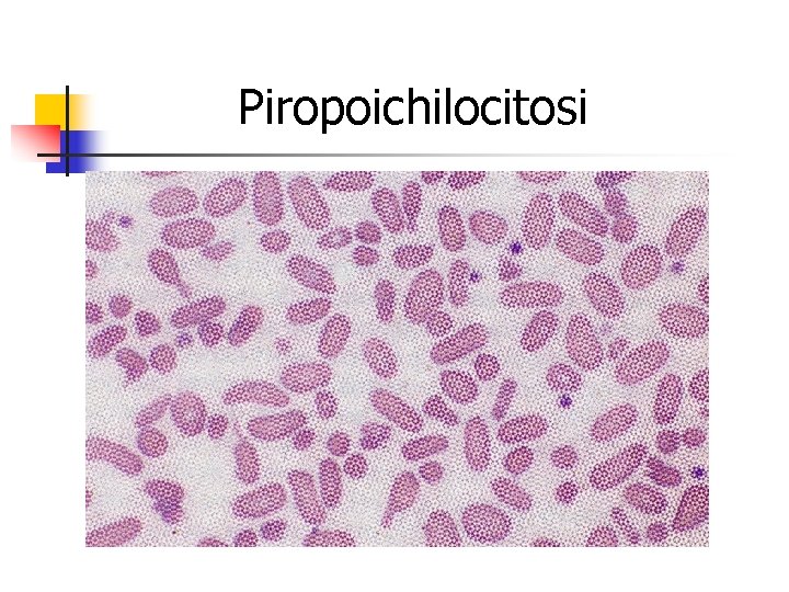 Piropoichilocitosi 
