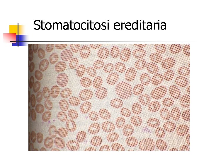 Stomatocitosi ereditaria 