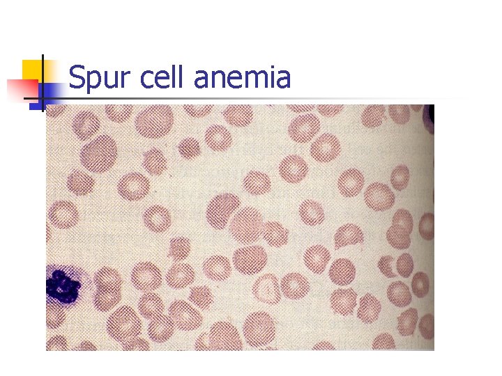 Spur cell anemia 