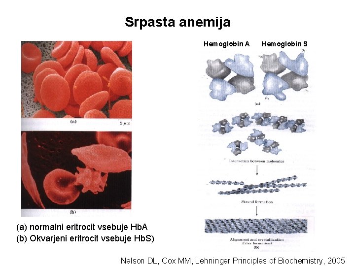 Srpasta anemija Hemoglobin A Hemoglobin S (a) normalni eritrocit vsebuje Hb. A (b) Okvarjeni