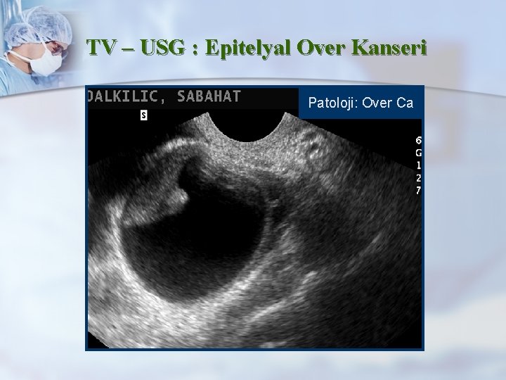 TV – USG : Epitelyal Over Kanseri Patoloji: Over Ca 