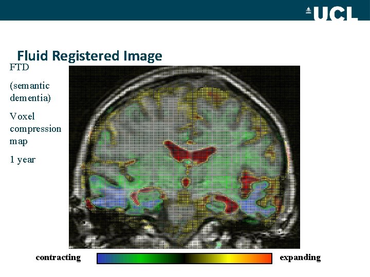 Fluid Registered Image FTD (semantic dementia) Voxel compression map 1 year contracting expanding 