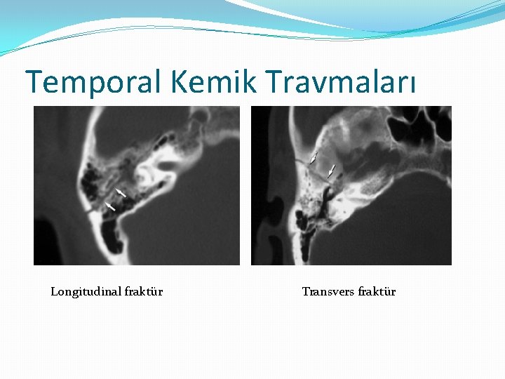 Temporal Kemik Travmaları Longitudinal fraktür Transvers fraktür 