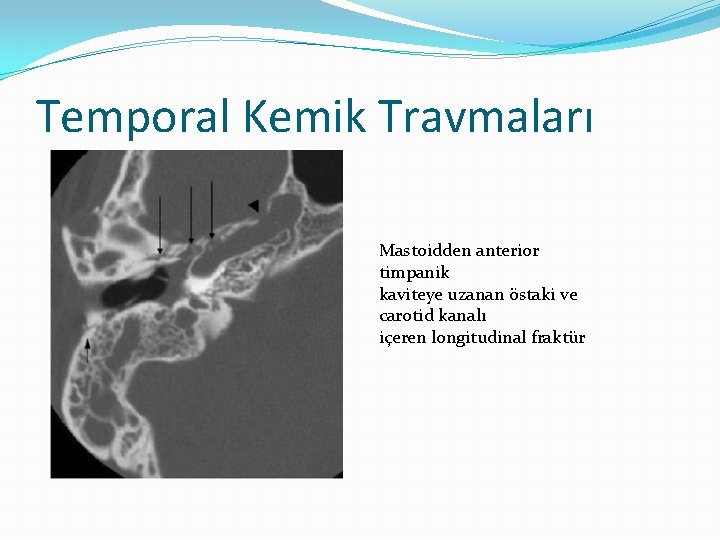 Temporal Kemik Travmaları Mastoidden anterior timpanik kaviteye uzanan östaki ve carotid kanalı içeren longitudinal