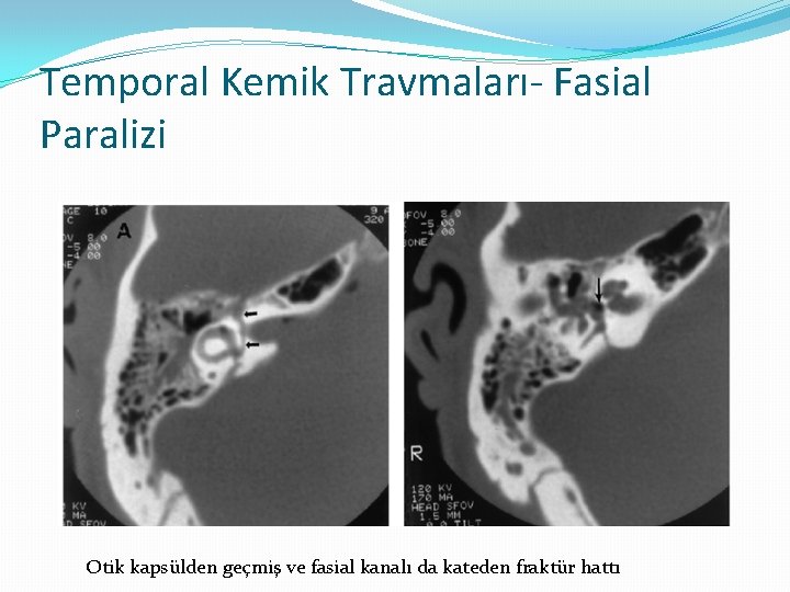 Temporal Kemik Travmaları- Fasial Paralizi Otik kapsülden geçmiş ve fasial kanalı da kateden fraktür